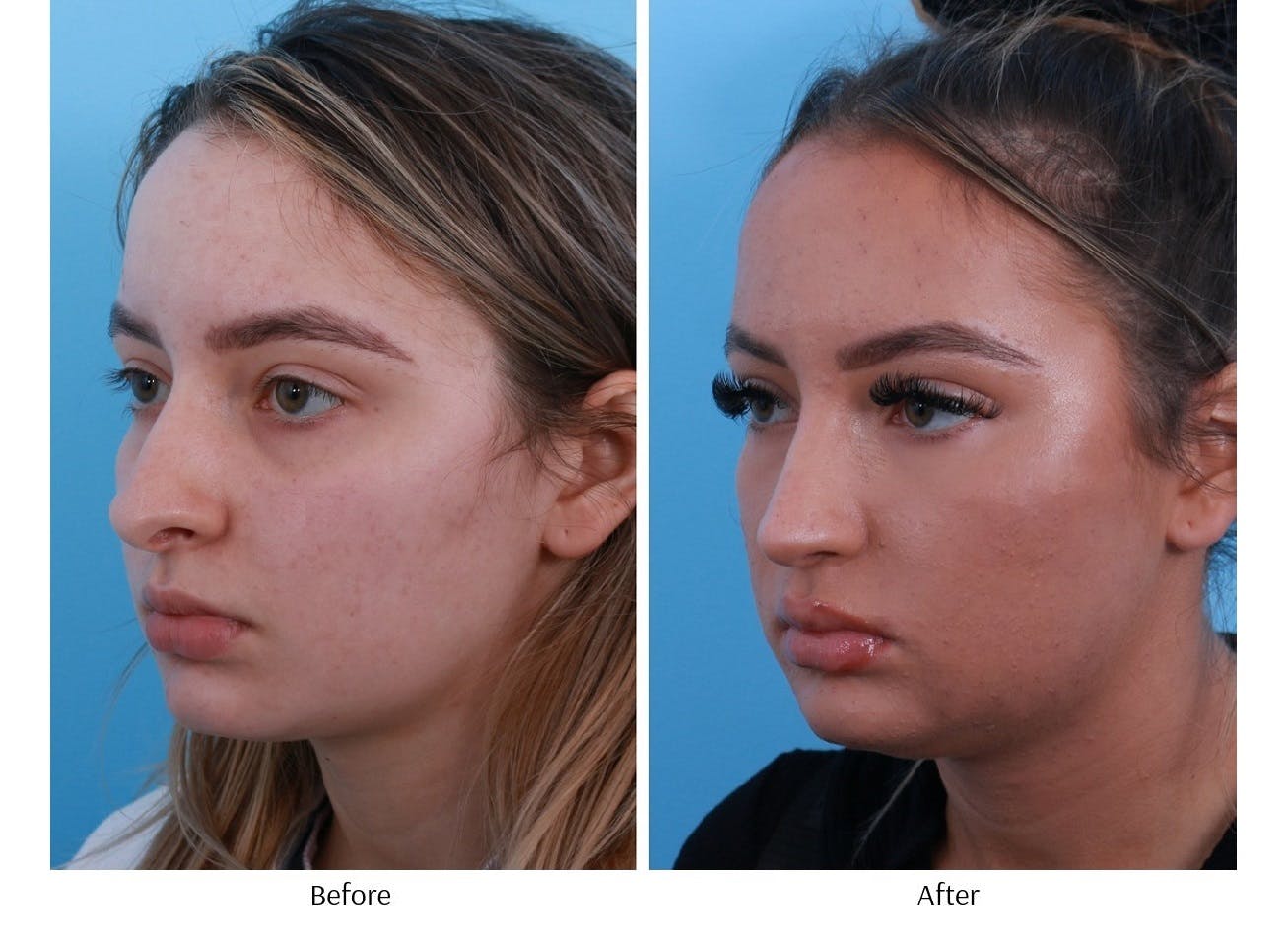 Rhinoplasty Before & After Gallery - Patient 64080971 - Image 3
