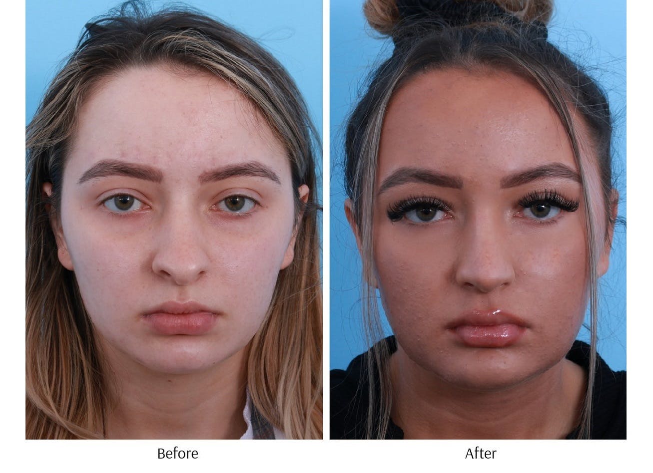 Rhinoplasty Before & After Gallery - Patient 64080971 - Image 4