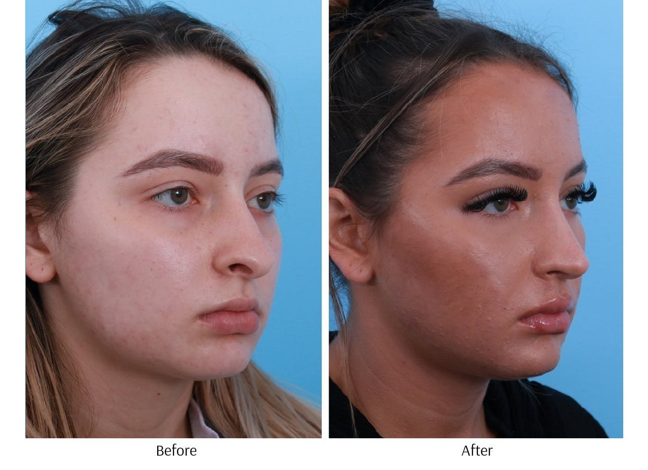 Rhinoplasty Before & After Gallery - Patient 64080971 - Image 5