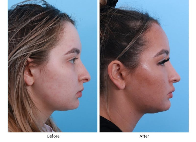 Rhinoplasty Before & After Gallery - Patient 64080971 - Image 1