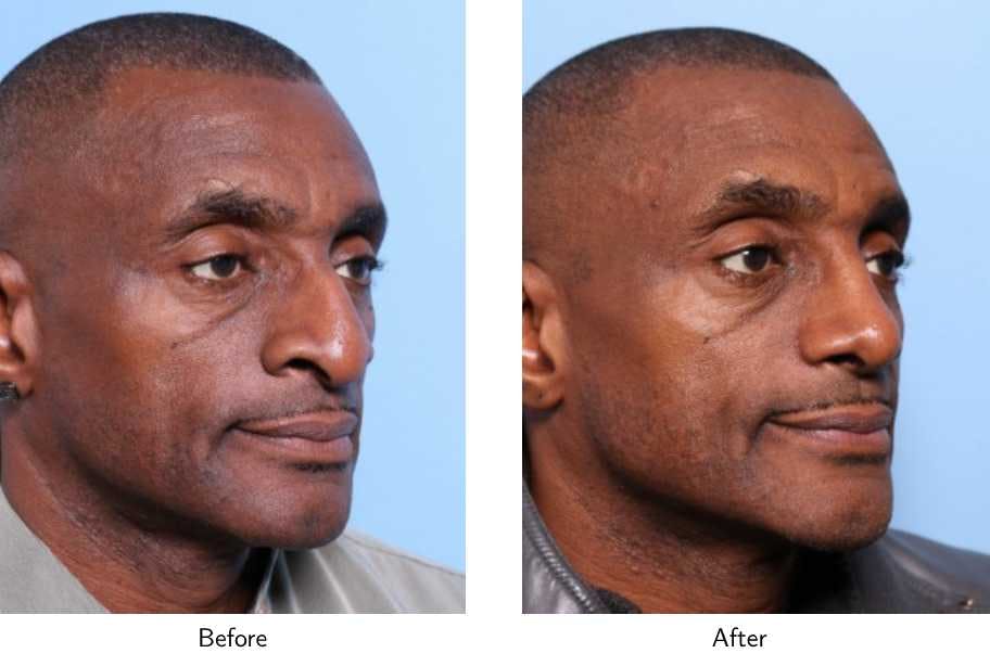 Rhinoplasty Before & After Gallery - Patient 64080973 - Image 3