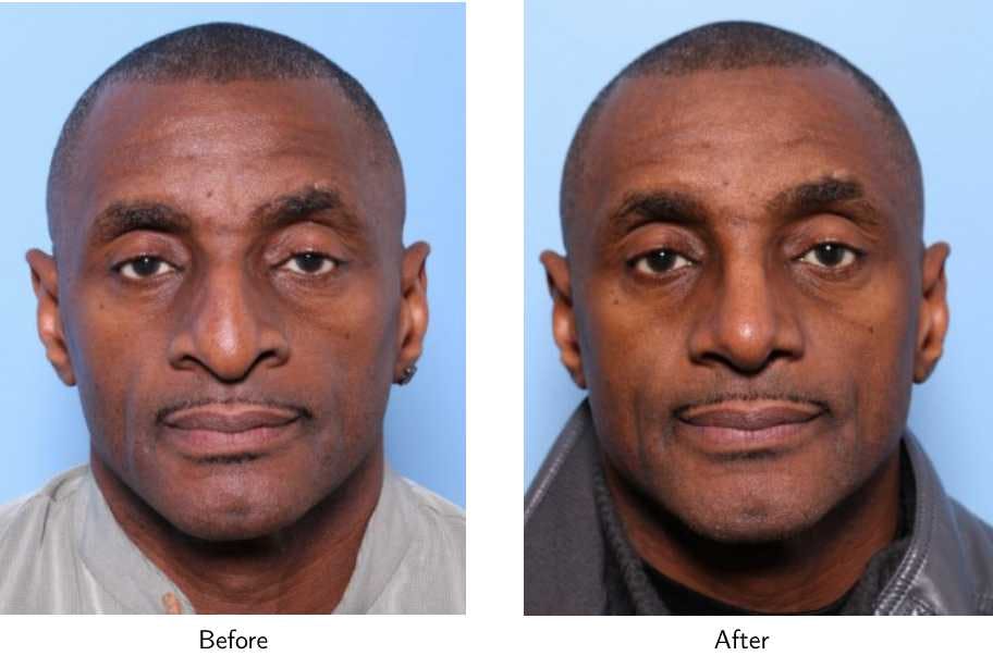 Rhinoplasty Before & After Gallery - Patient 64080973 - Image 4