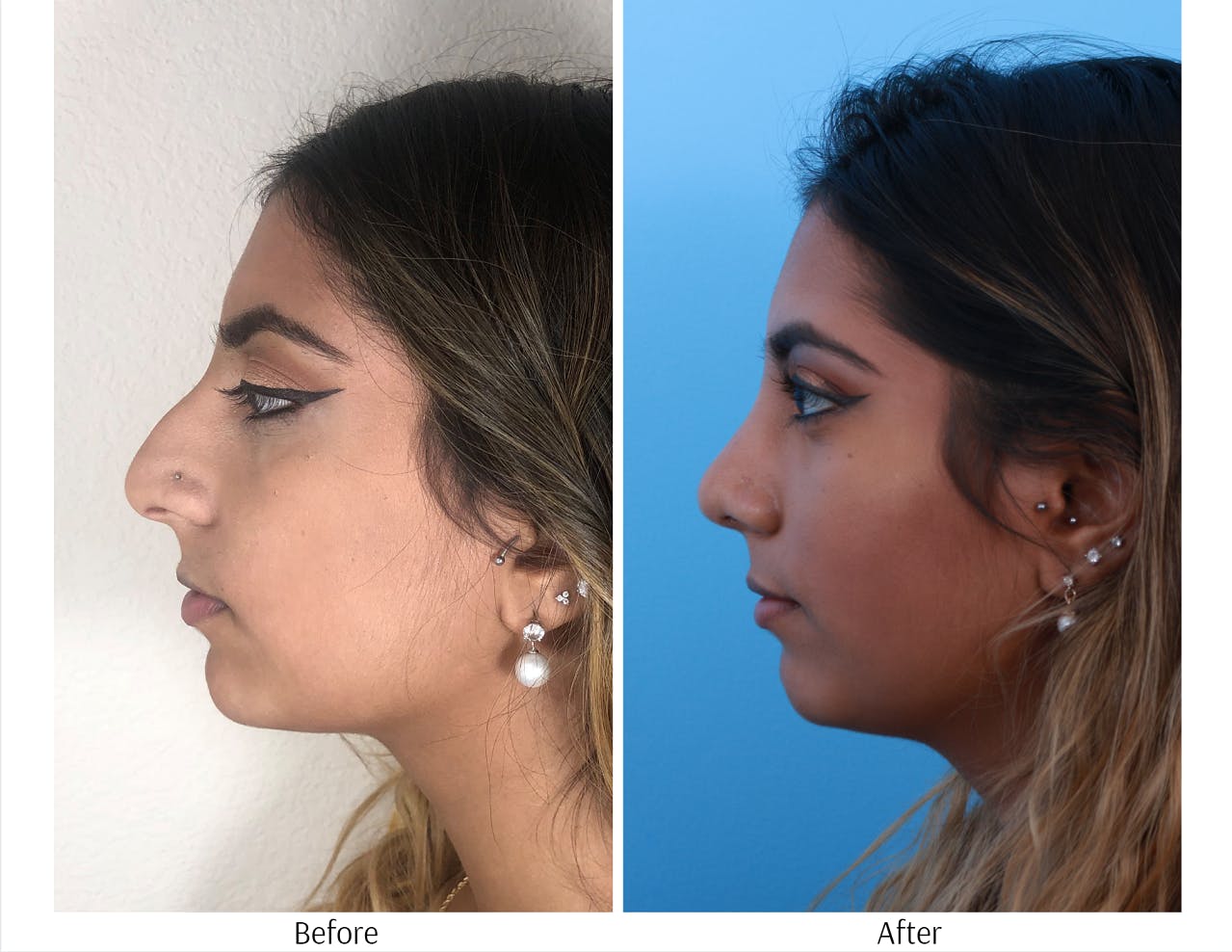 Rhinoplasty Before & After Gallery - Patient 64080974 - Image 2