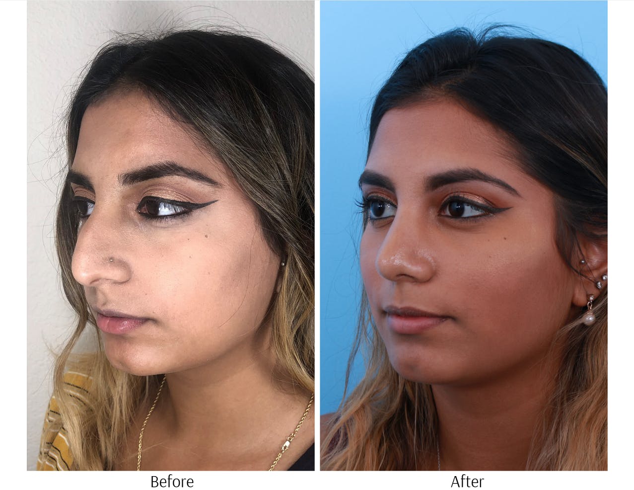 Rhinoplasty Before & After Gallery - Patient 64080974 - Image 3