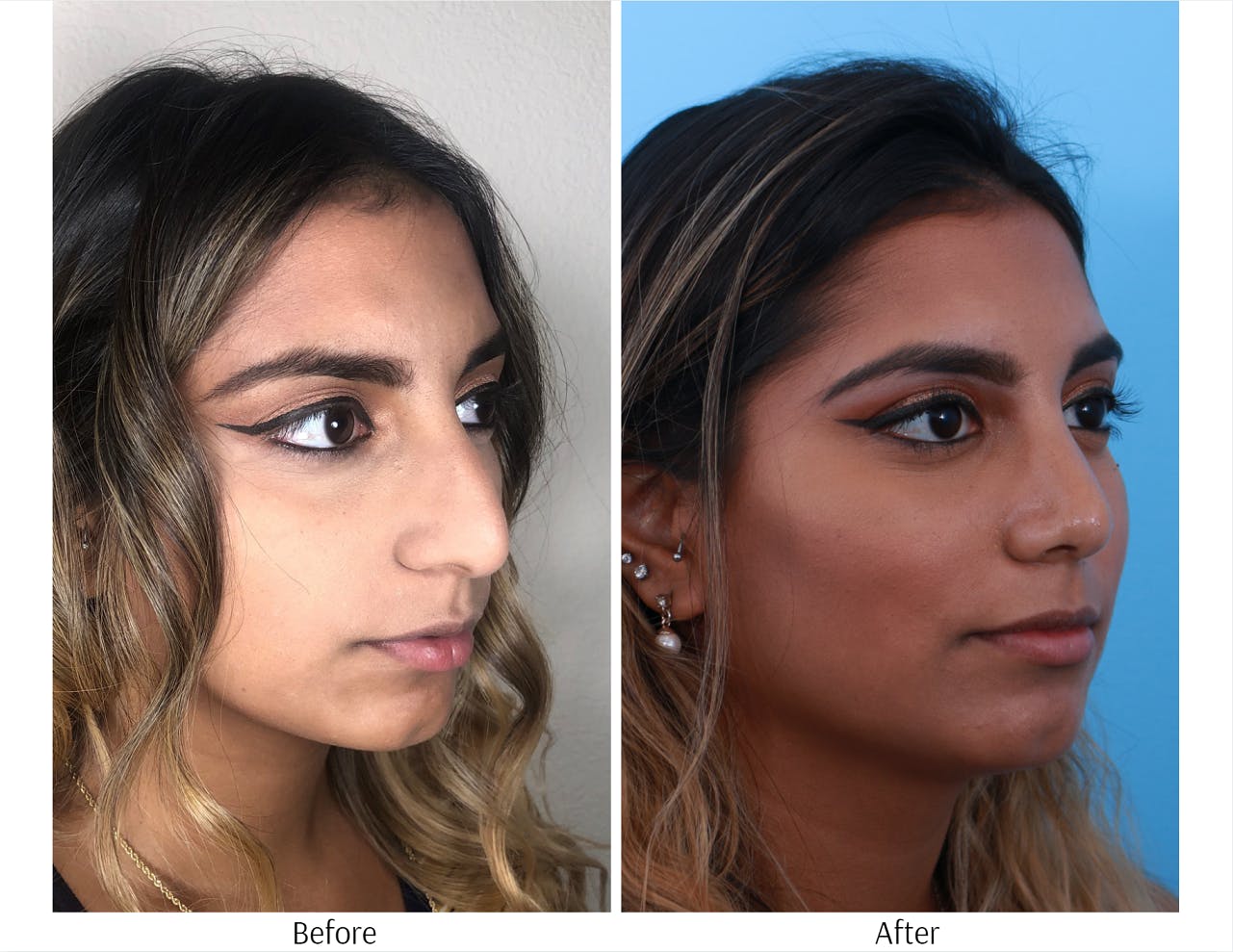 Rhinoplasty Before & After Gallery - Patient 64080974 - Image 4