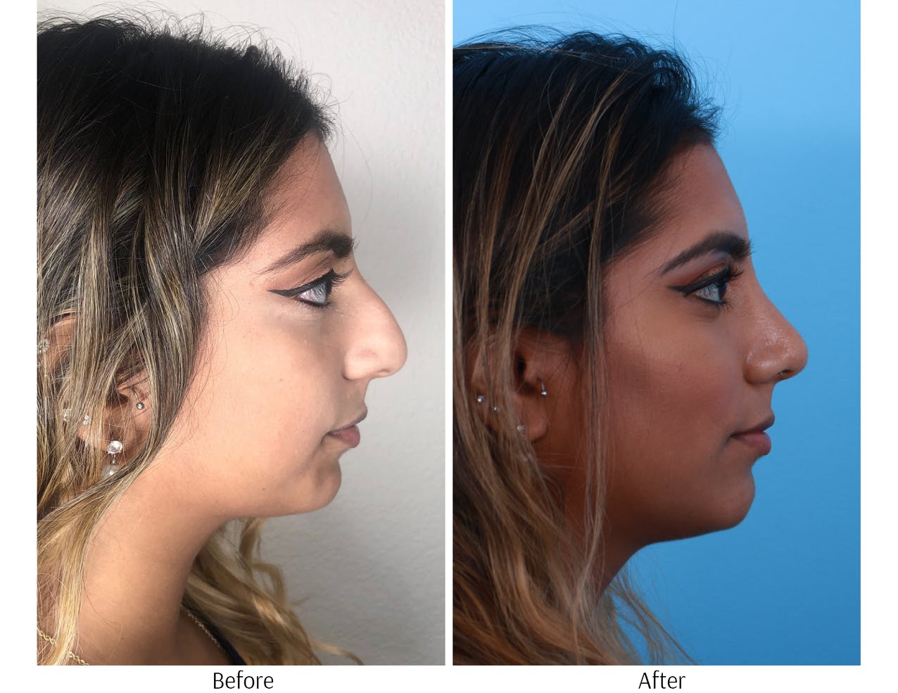 Rhinoplasty Before & After Gallery - Patient 64080974 - Image 5