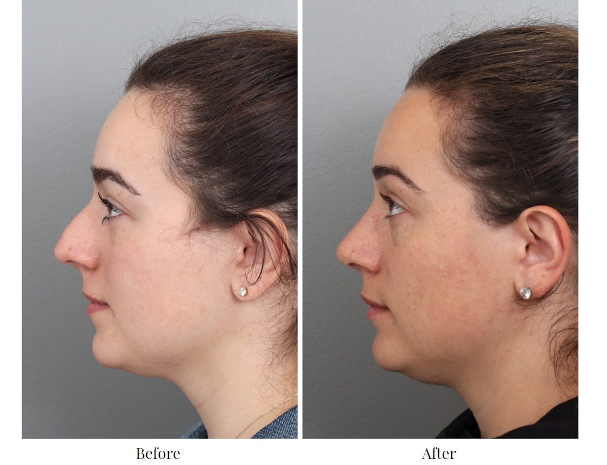 Rhinoplasty Before & After Gallery - Patient 64080983 - Image 2