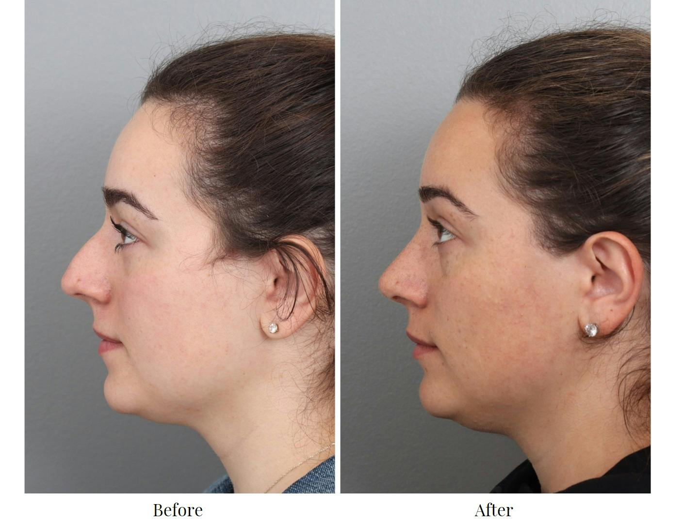 Rhinoplasty Before & After Gallery - Patient 64080983 - Image 2
