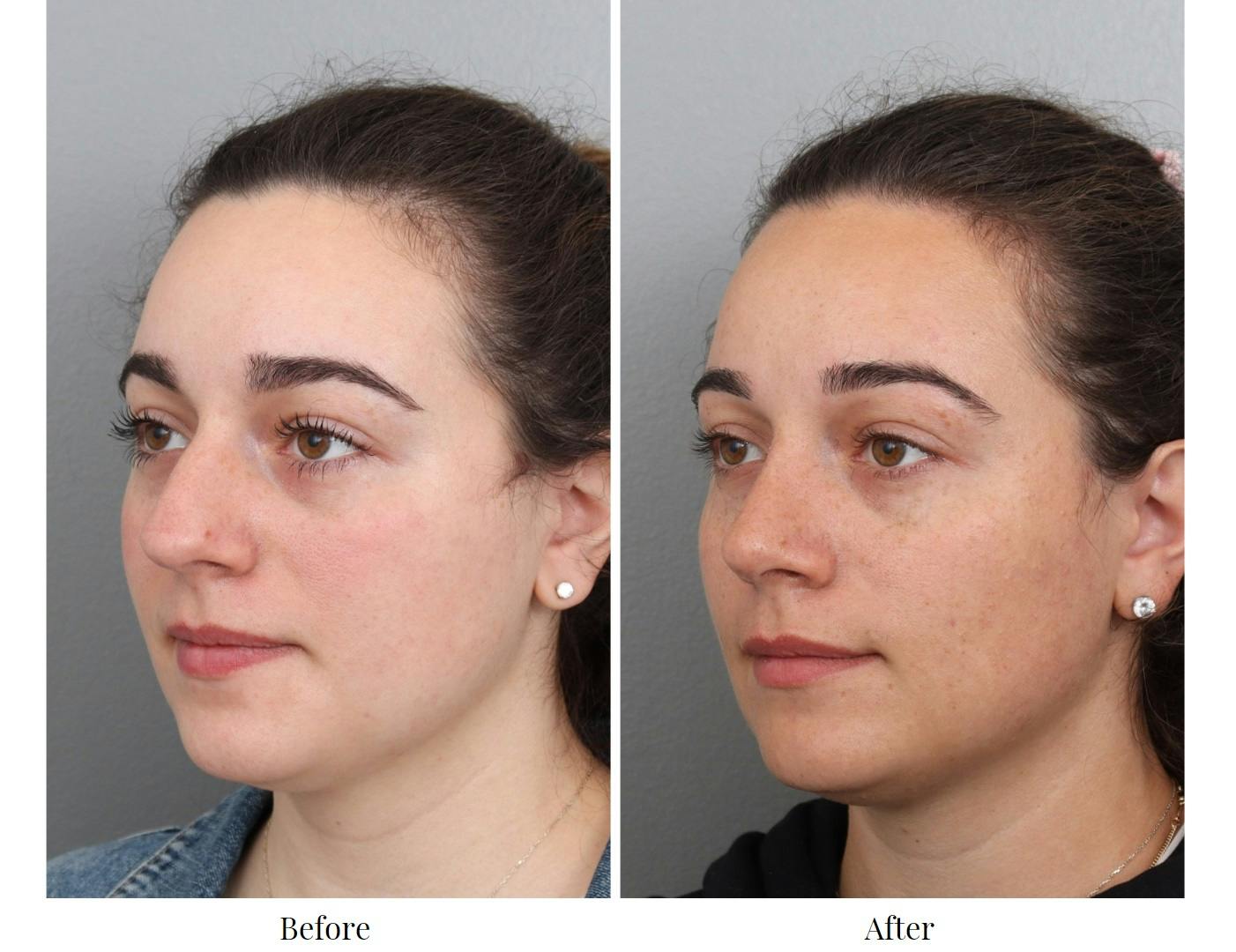 Rhinoplasty Before & After Gallery - Patient 64080983 - Image 3
