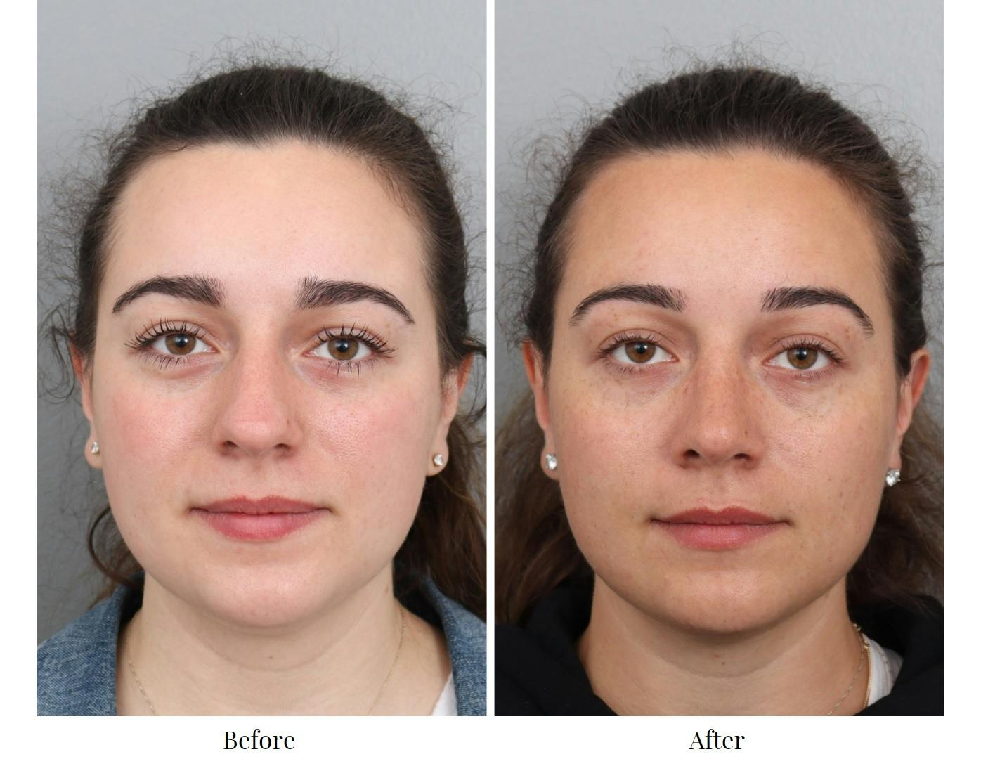 Rhinoplasty Before & After Gallery - Patient 64080983 - Image 4