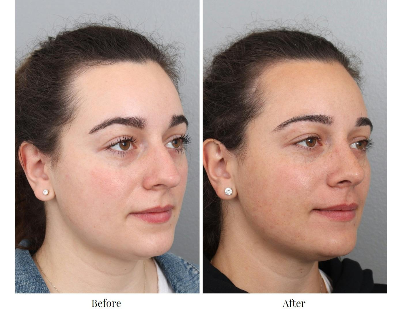 Rhinoplasty Before & After Gallery - Patient 64080983 - Image 5