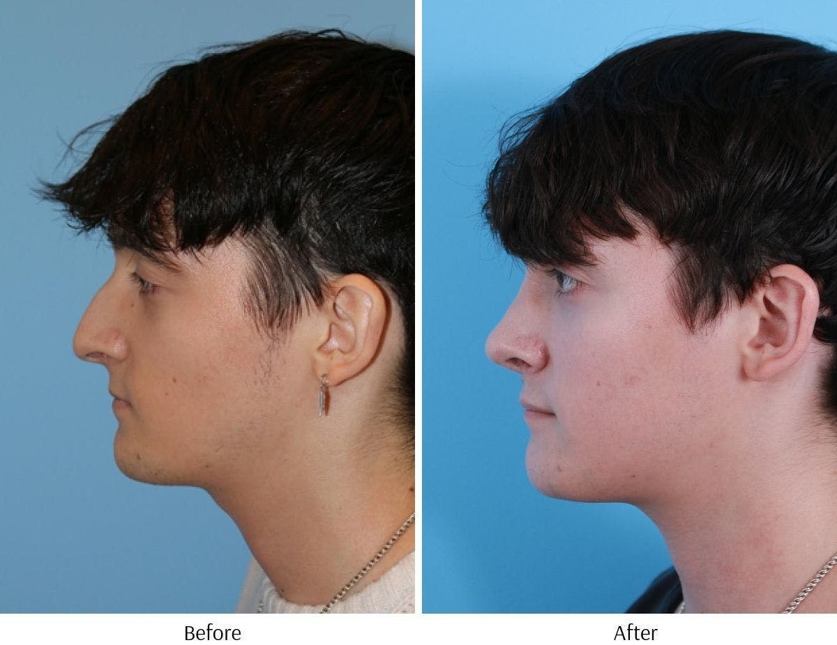 Rhinoplasty Before & After Gallery - Patient 64080984 - Image 3