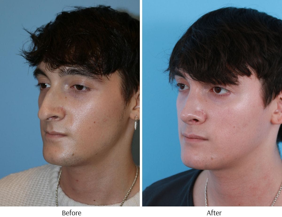 Rhinoplasty Before & After Gallery - Patient 64080984 - Image 4