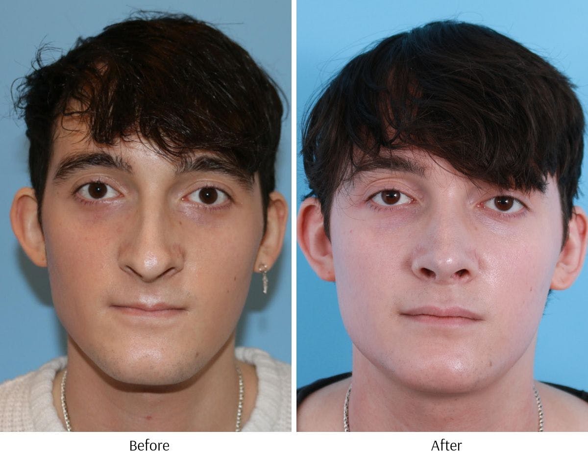 Rhinoplasty Before & After Gallery - Patient 64080984 - Image 2