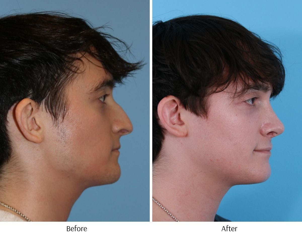 Rhinoplasty Before & After Gallery - Patient 64080984 - Image 5