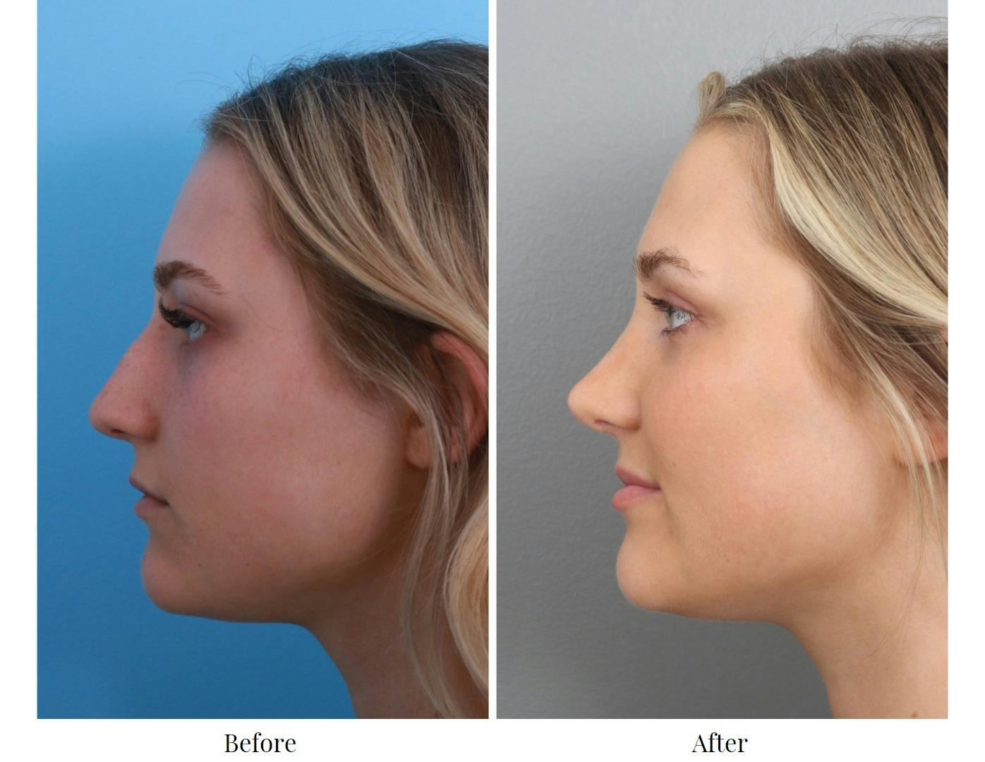 Rhinoplasty Before & After Gallery - Patient 64080985 - Image 2