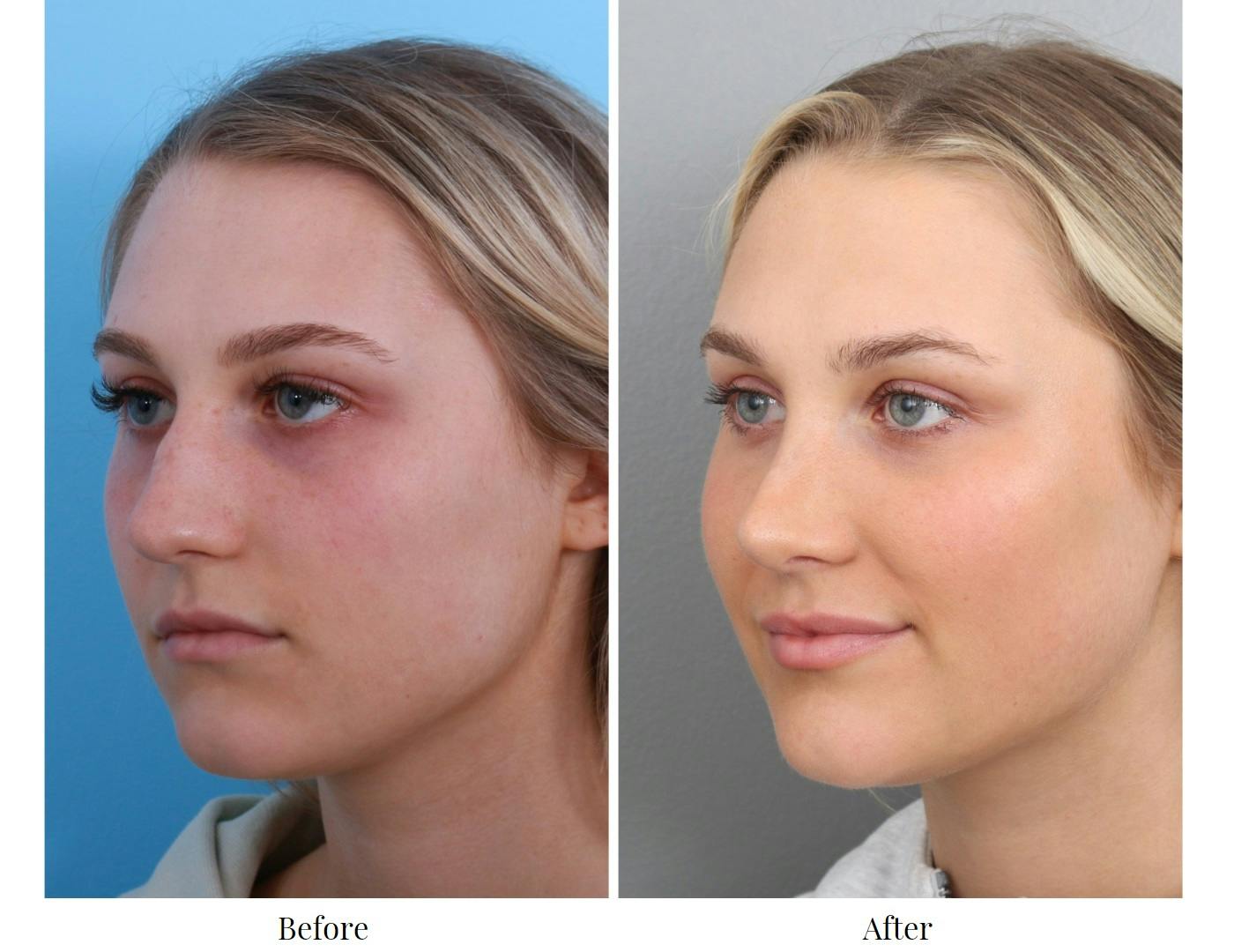 Rhinoplasty Before & After Gallery - Patient 64080985 - Image 3