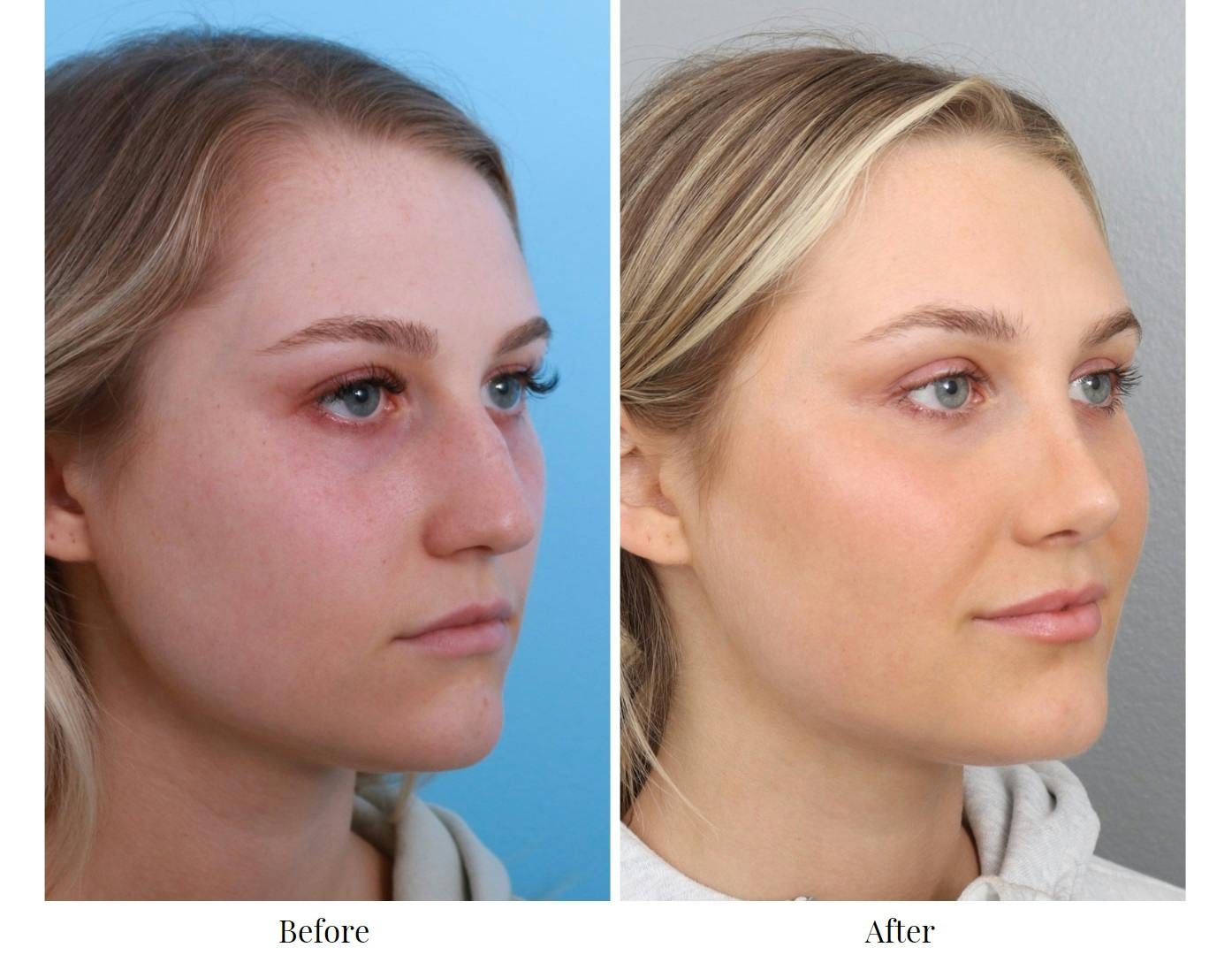 Rhinoplasty Before & After Gallery - Patient 64080985 - Image 5