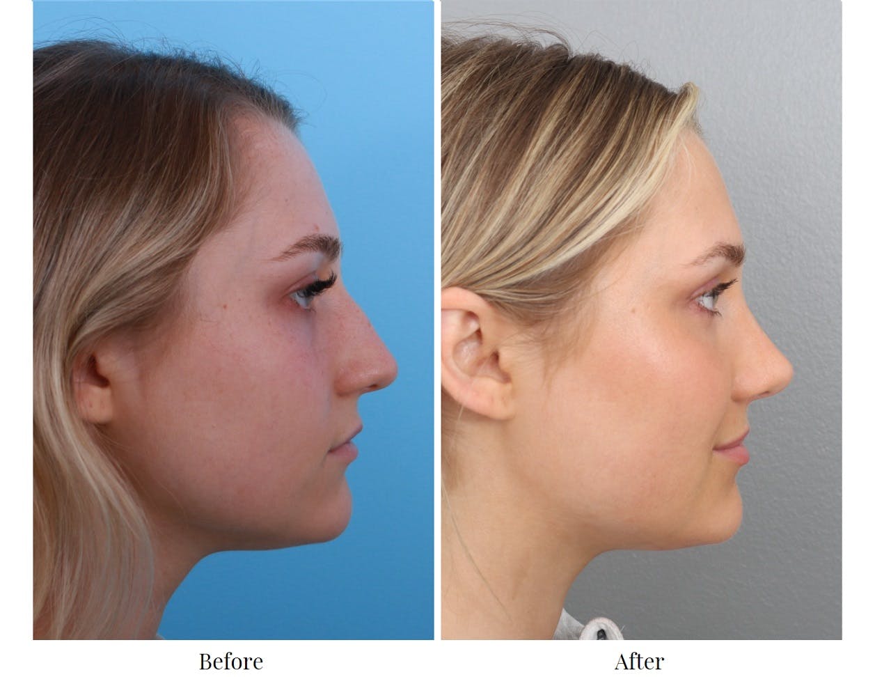 Rhinoplasty Before & After Gallery - Patient 64080985 - Image 4