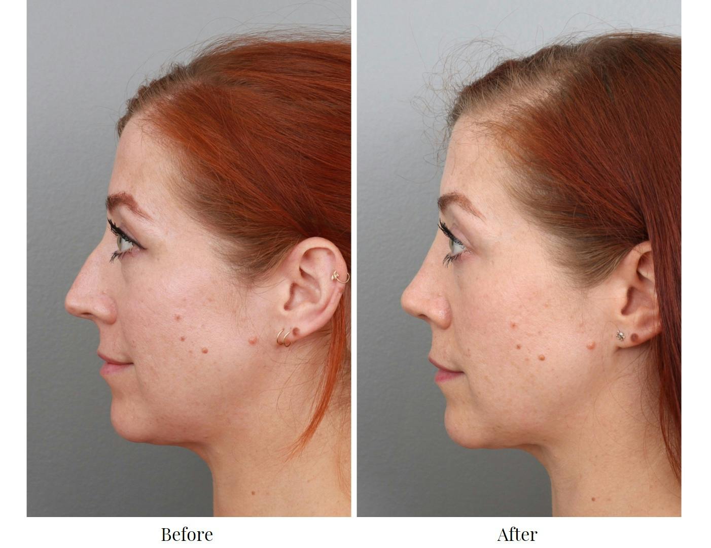 Rhinoplasty Before & After Gallery - Patient 64080986 - Image 2