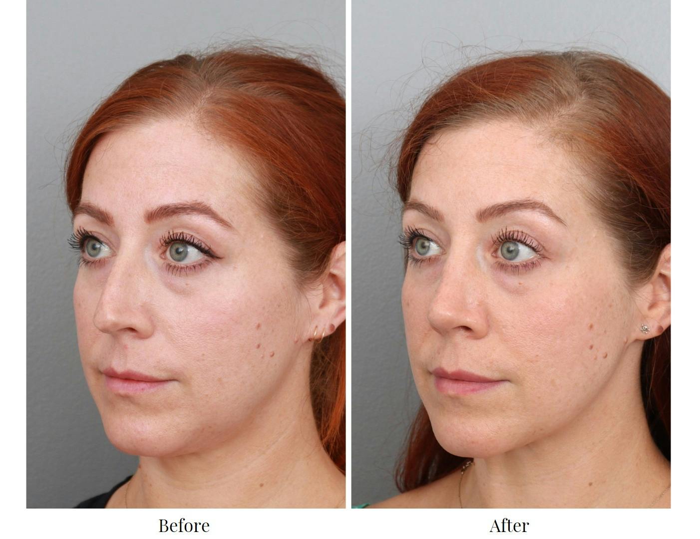 Rhinoplasty Before & After Gallery - Patient 64080986 - Image 3