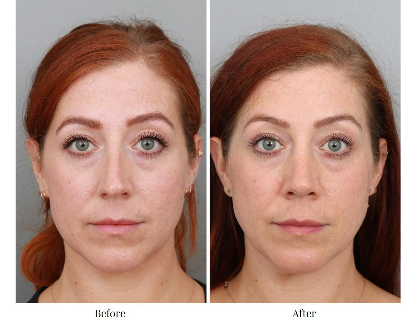 Rhinoplasty Before & After Gallery - Patient 64080986 - Image 4
