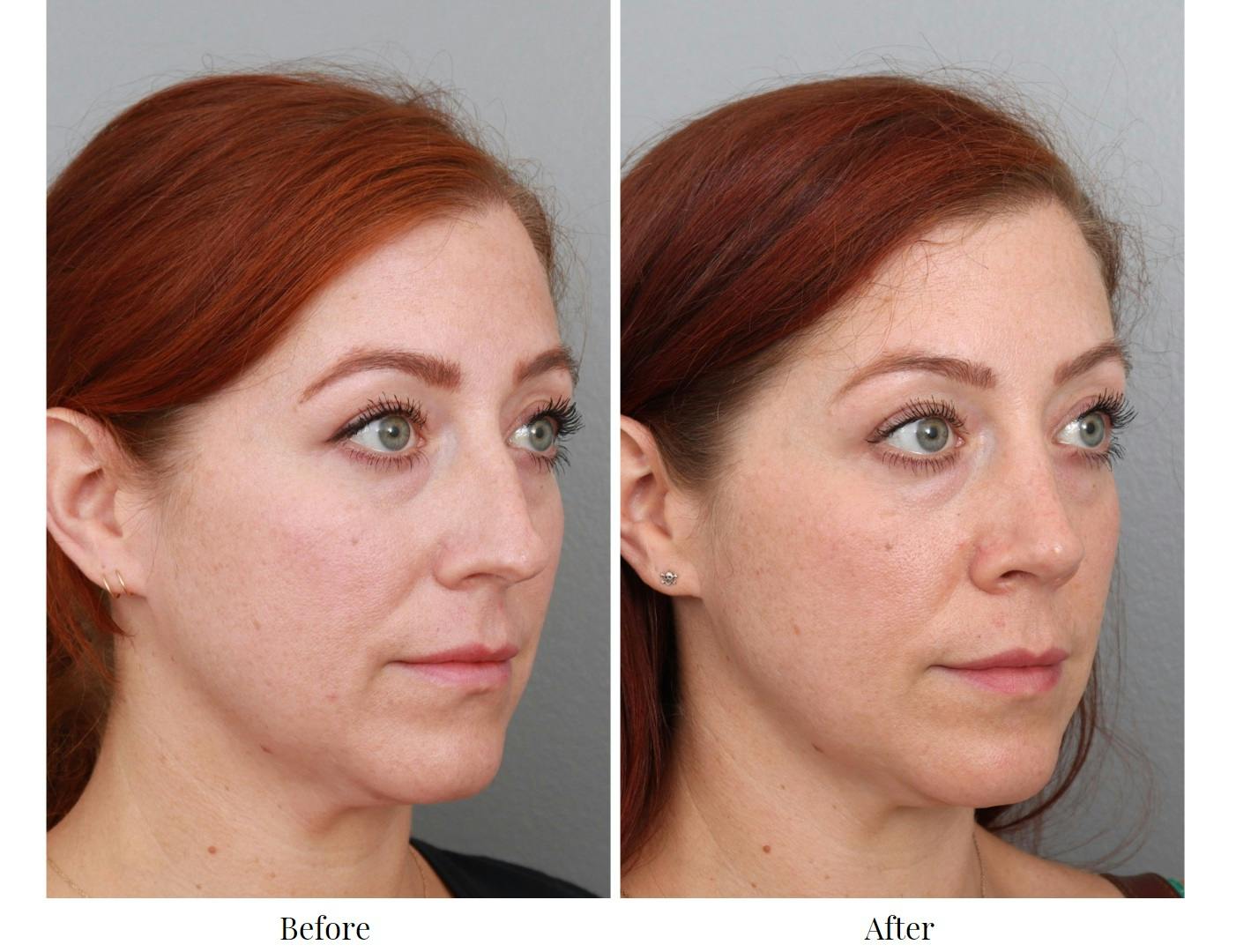 Rhinoplasty Before & After Gallery - Patient 64080986 - Image 1