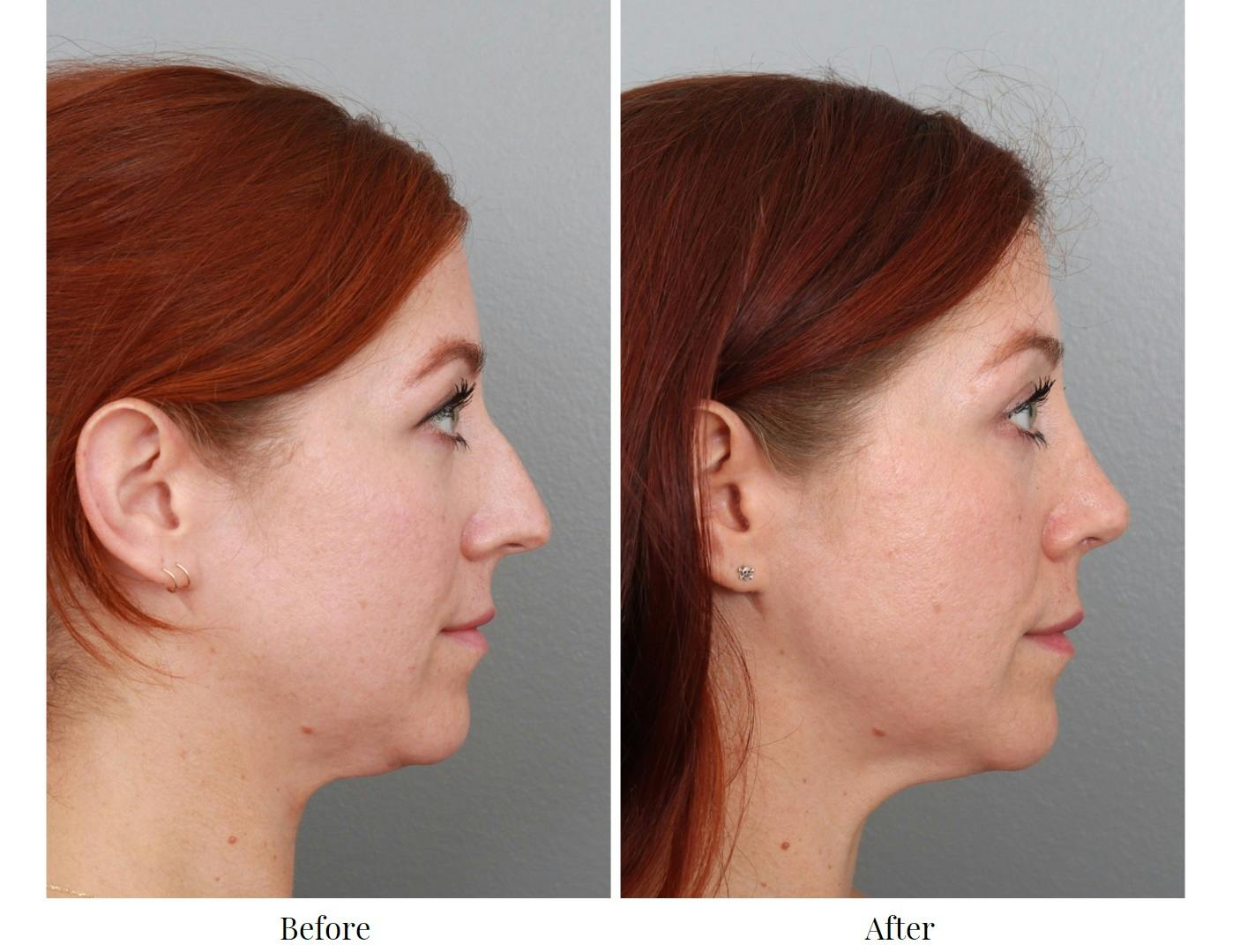 Rhinoplasty Before & After Gallery - Patient 64080986 - Image 5