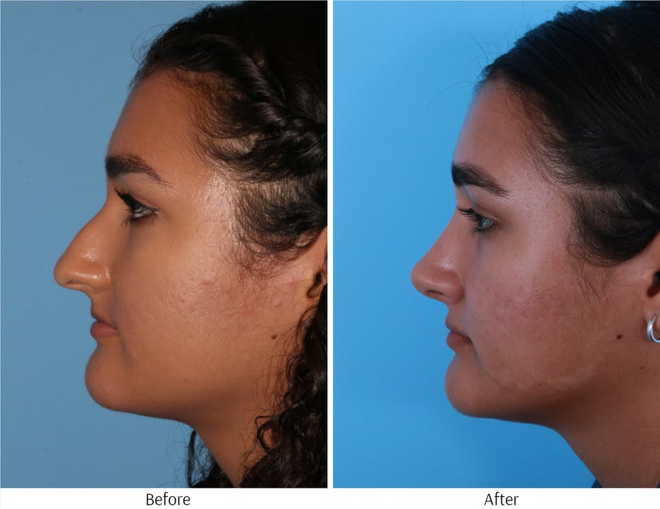 Rhinoplasty Before & After Gallery - Patient 64080987 - Image 2