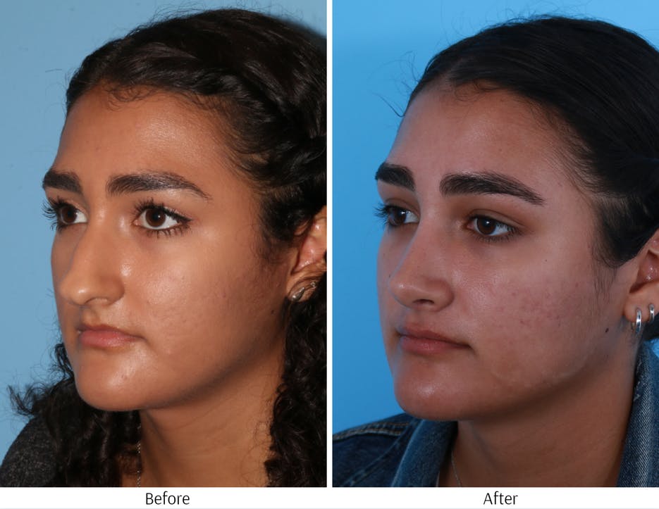 Rhinoplasty Before & After Gallery - Patient 64080987 - Image 3