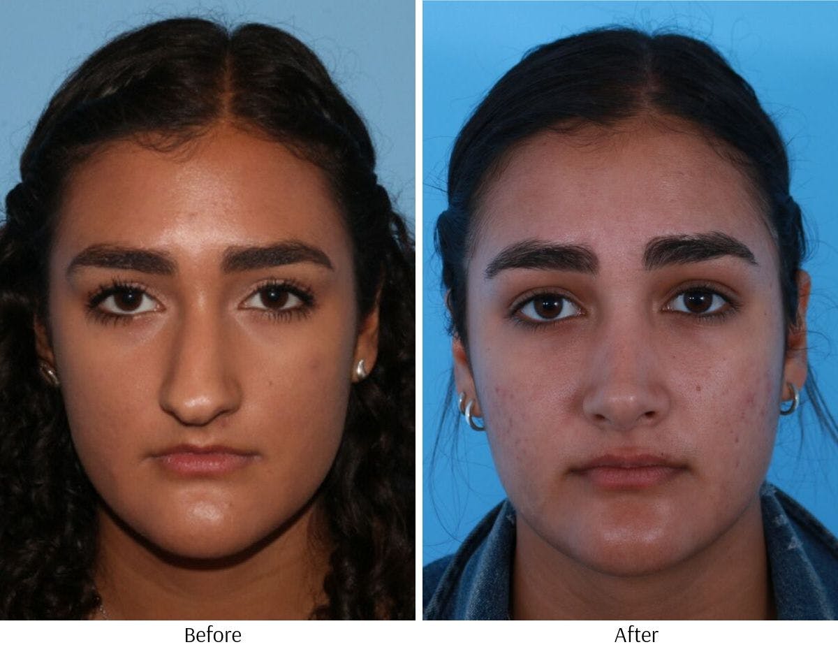 Rhinoplasty Before & After Gallery - Patient 64080987 - Image 4
