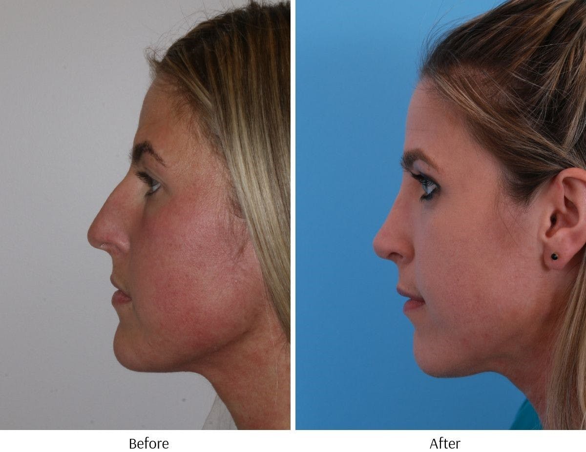 Rhinoplasty Before & After Gallery - Patient 64080988 - Image 2
