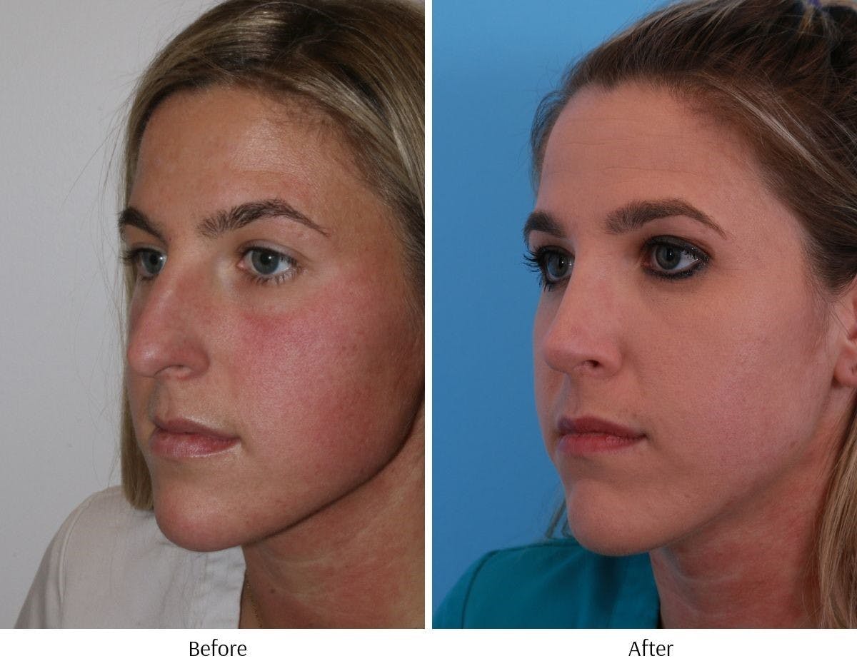 Rhinoplasty Before & After Gallery - Patient 64080988 - Image 3