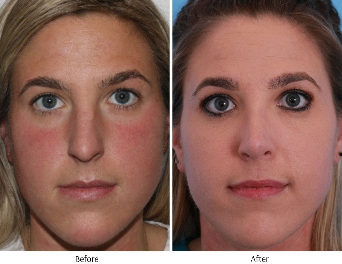 Rhinoplasty Before & After Gallery - Patient 64080988 - Image 1