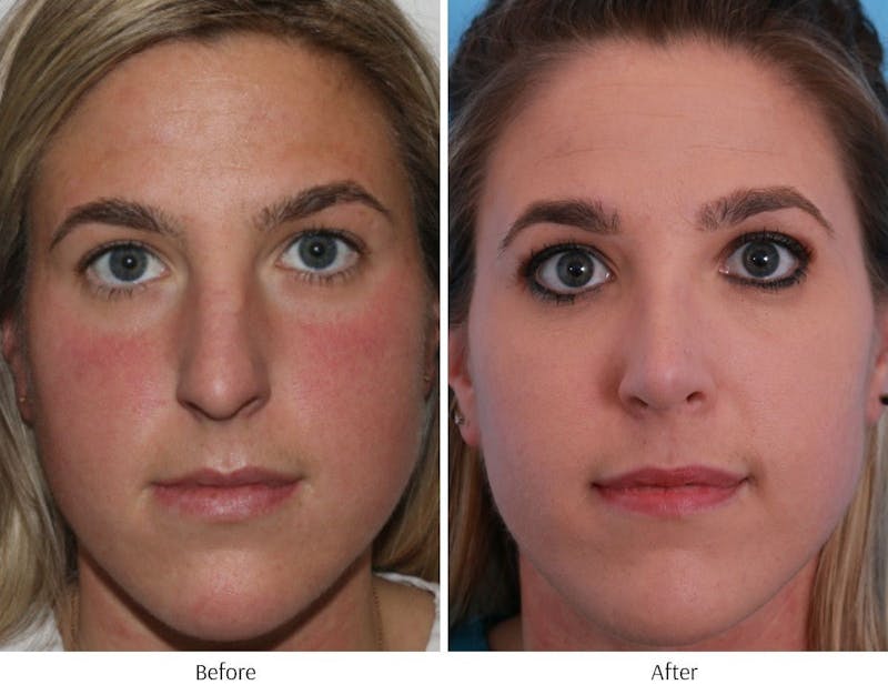 Rhinoplasty Before & After Gallery - Patient 64080988 - Image 1