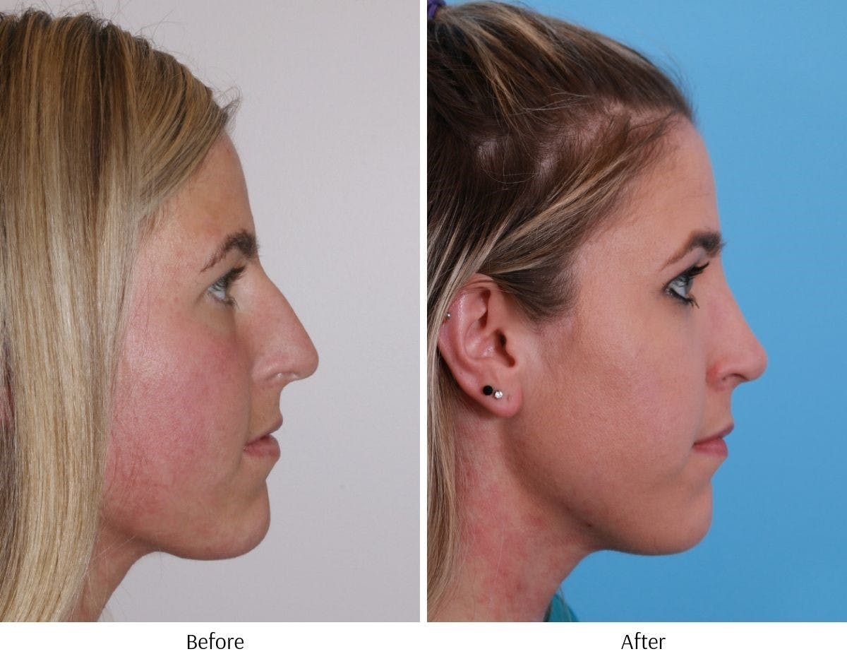 Rhinoplasty Before & After Gallery - Patient 64080988 - Image 4
