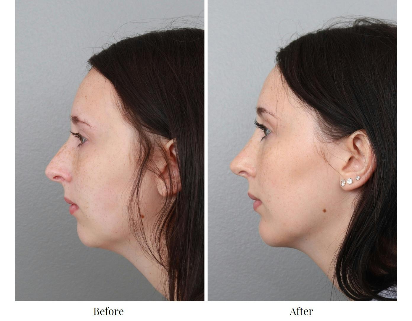 Rhinoplasty Before & After Gallery - Patient 64080997 - Image 2