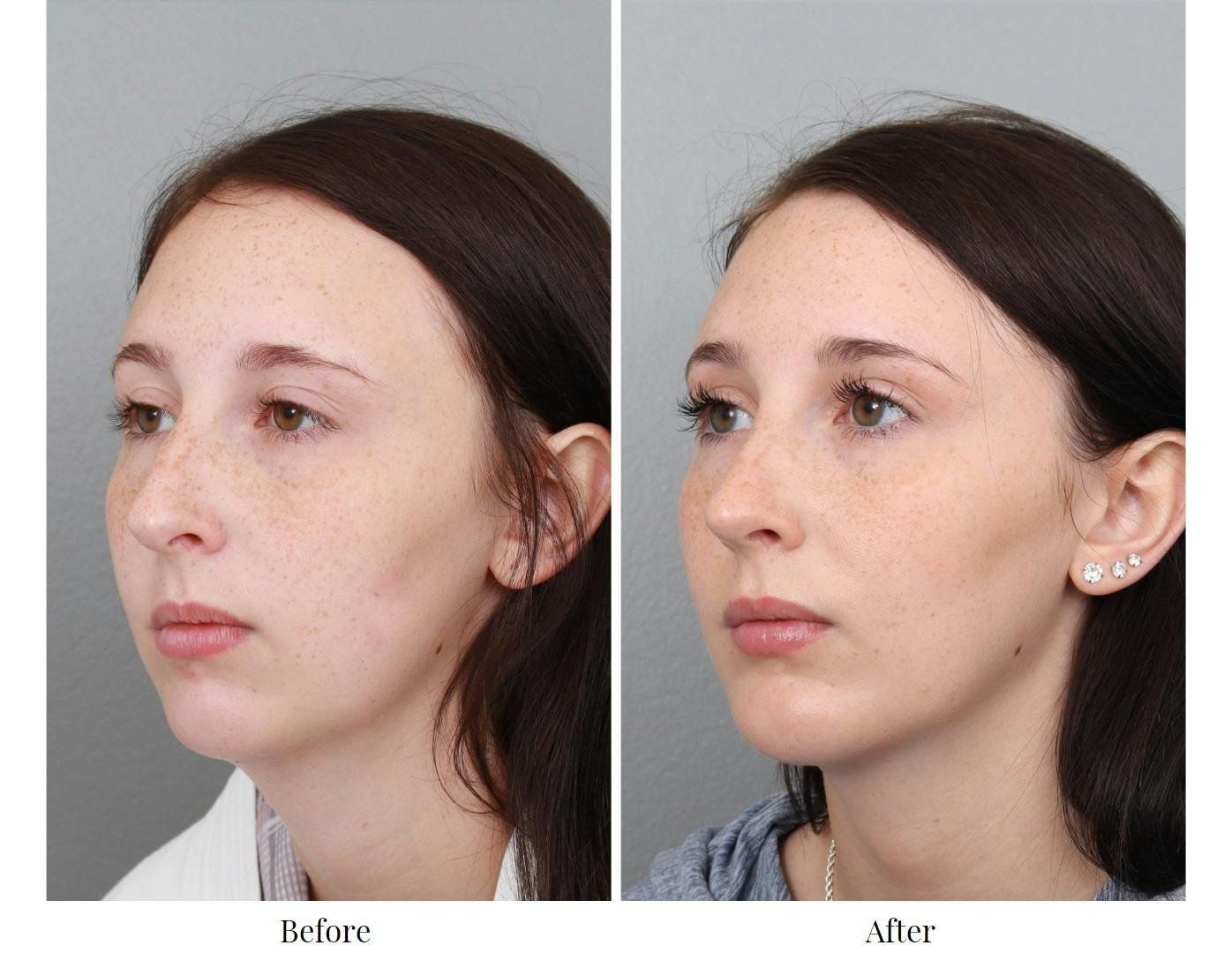 Rhinoplasty Before & After Gallery - Patient 64080997 - Image 3