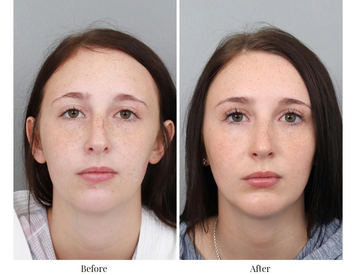 Rhinoplasty Before & After Gallery - Patient 64080997 - Image 4