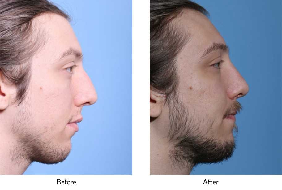 Rhinoplasty Before & After Gallery - Patient 64080998 - Image 2