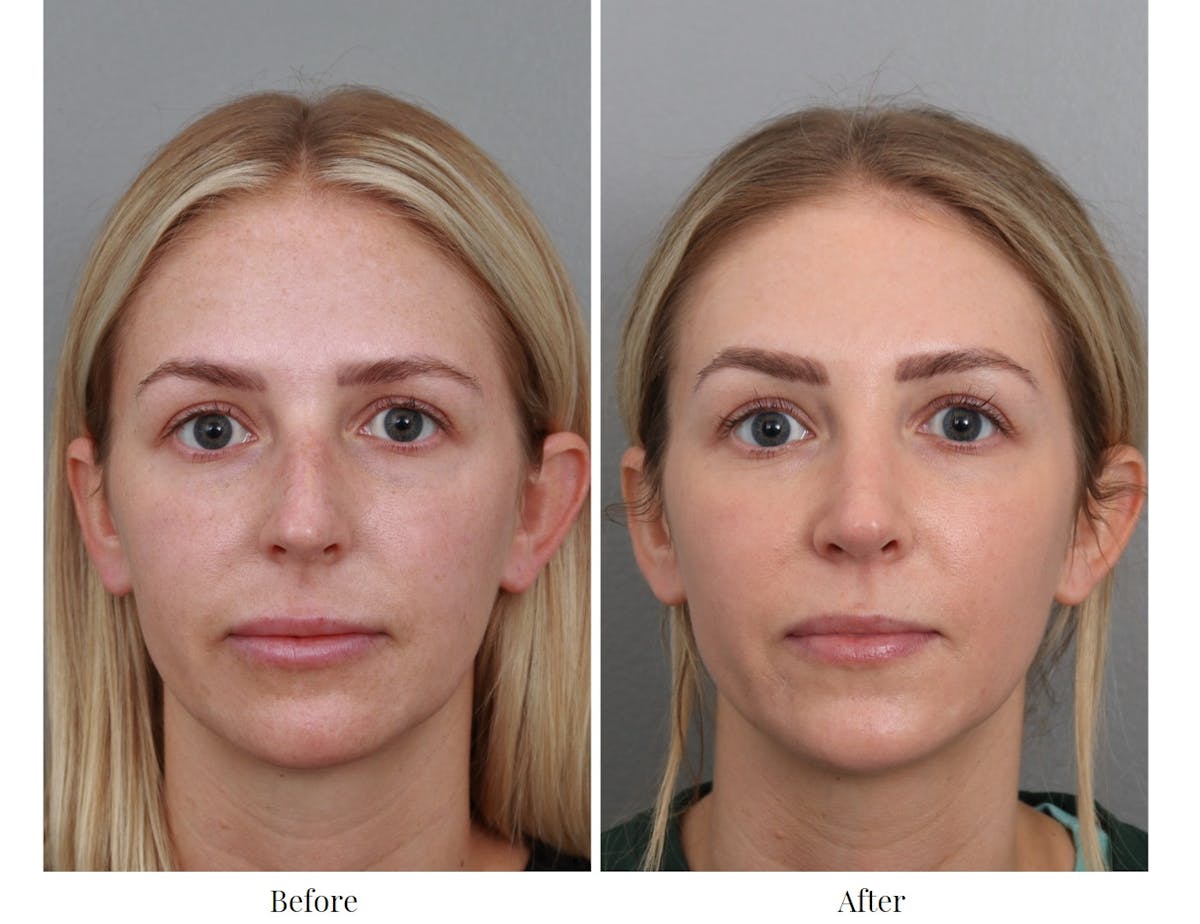 Rhinoplasty Before & After Gallery - Patient 64080999 - Image 2