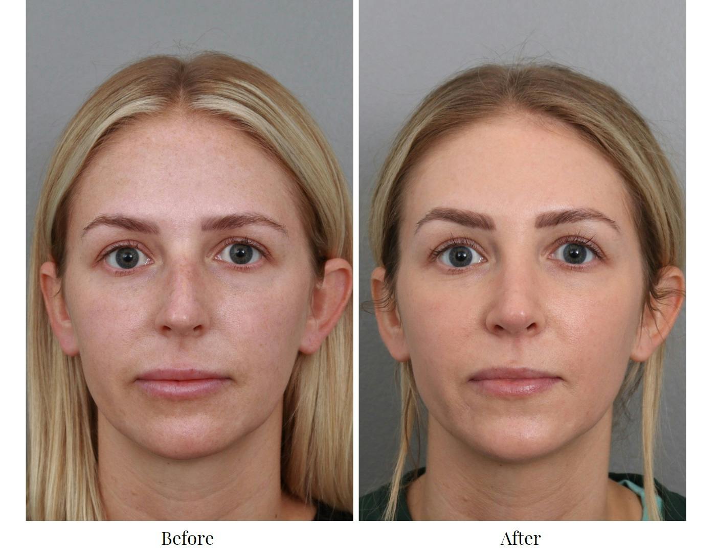 Rhinoplasty Before & After Gallery - Patient 64080999 - Image 2