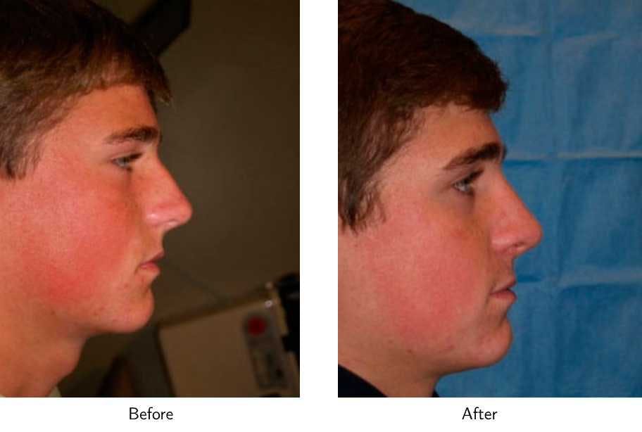 Rhinoplasty Before & After Gallery - Patient 64081000 - Image 2