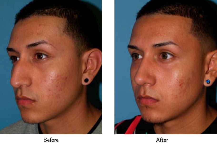 Rhinoplasty Before & After Gallery - Patient 64081001 - Image 2