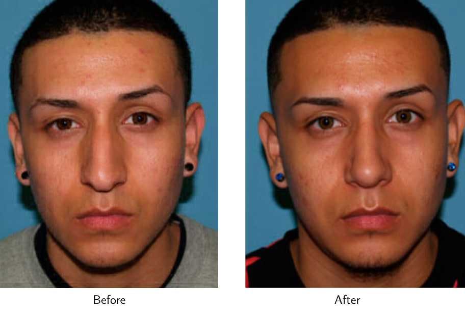 Rhinoplasty Before & After Gallery - Patient 64081001 - Image 4