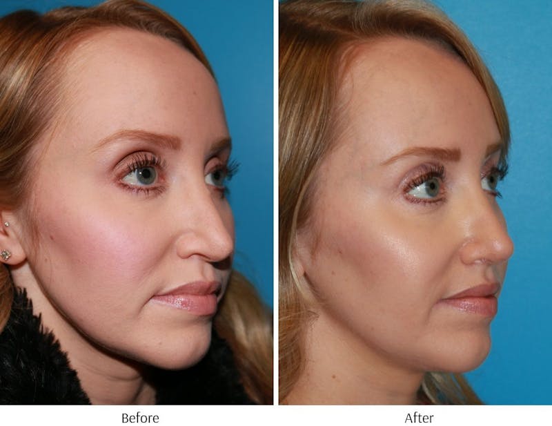 Revision Rhinoplasty Before & After Gallery - Patient 64081002 - Image 1