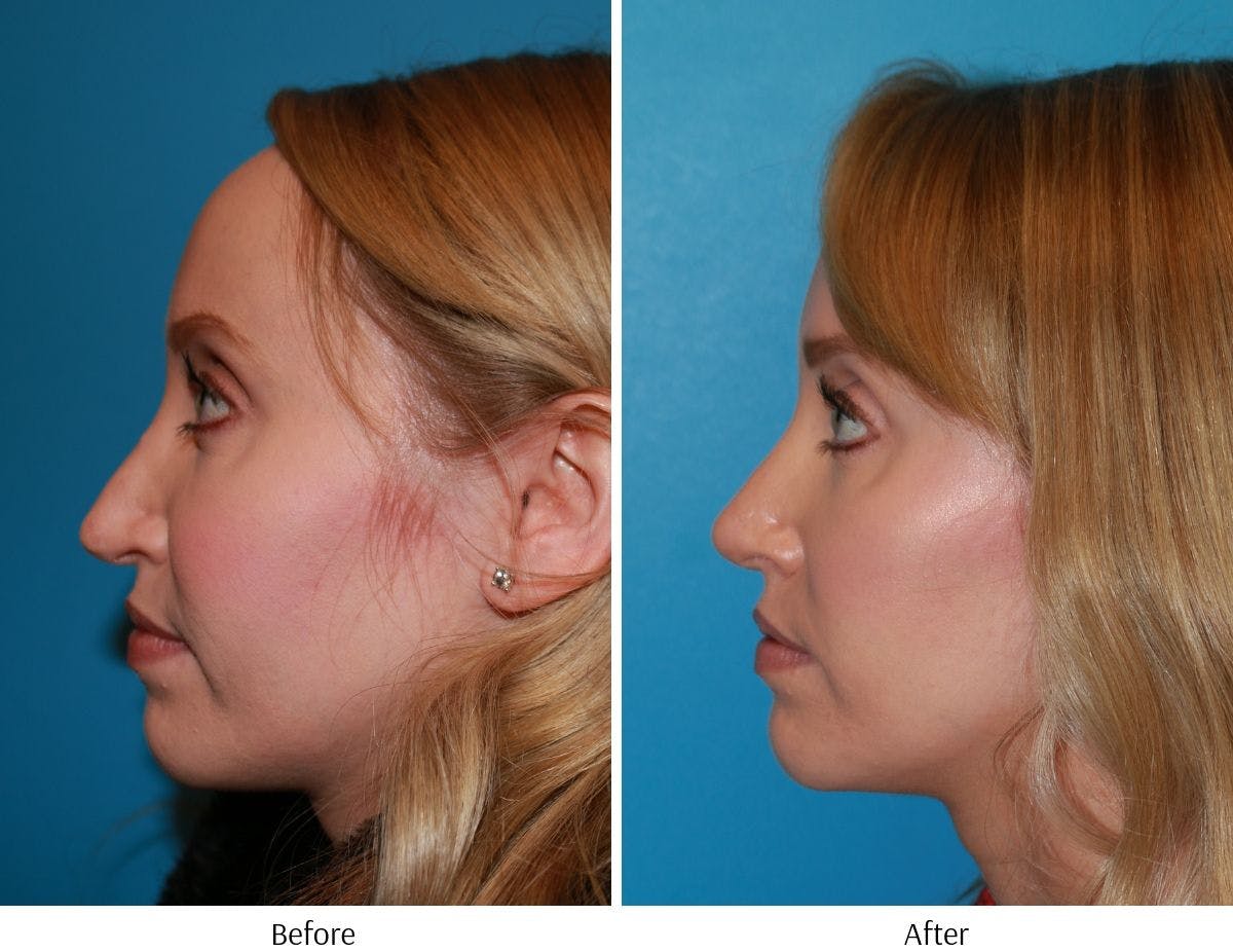 Revision Rhinoplasty Before & After Gallery - Patient 64081002 - Image 2