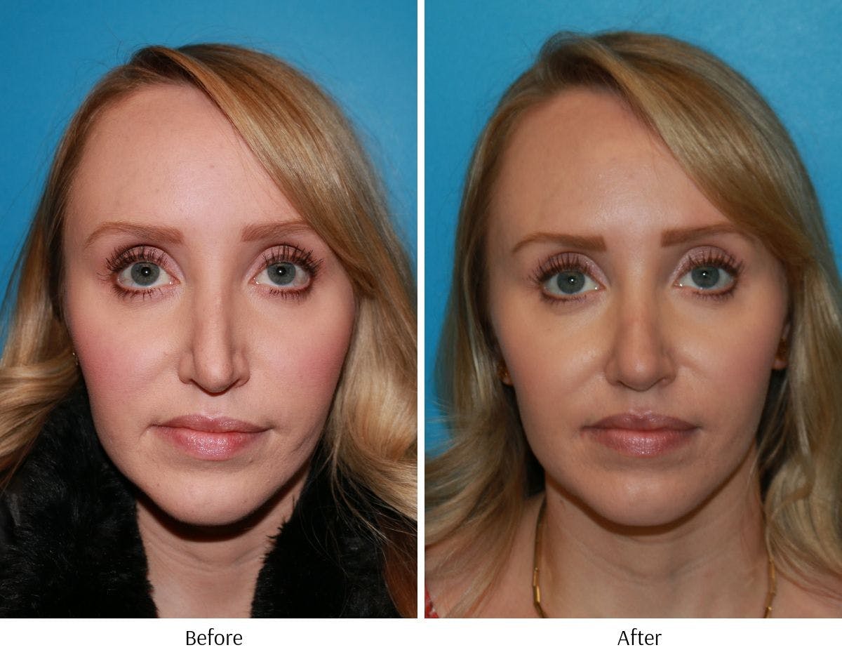 Revision Rhinoplasty Before & After Gallery - Patient 64081002 - Image 3