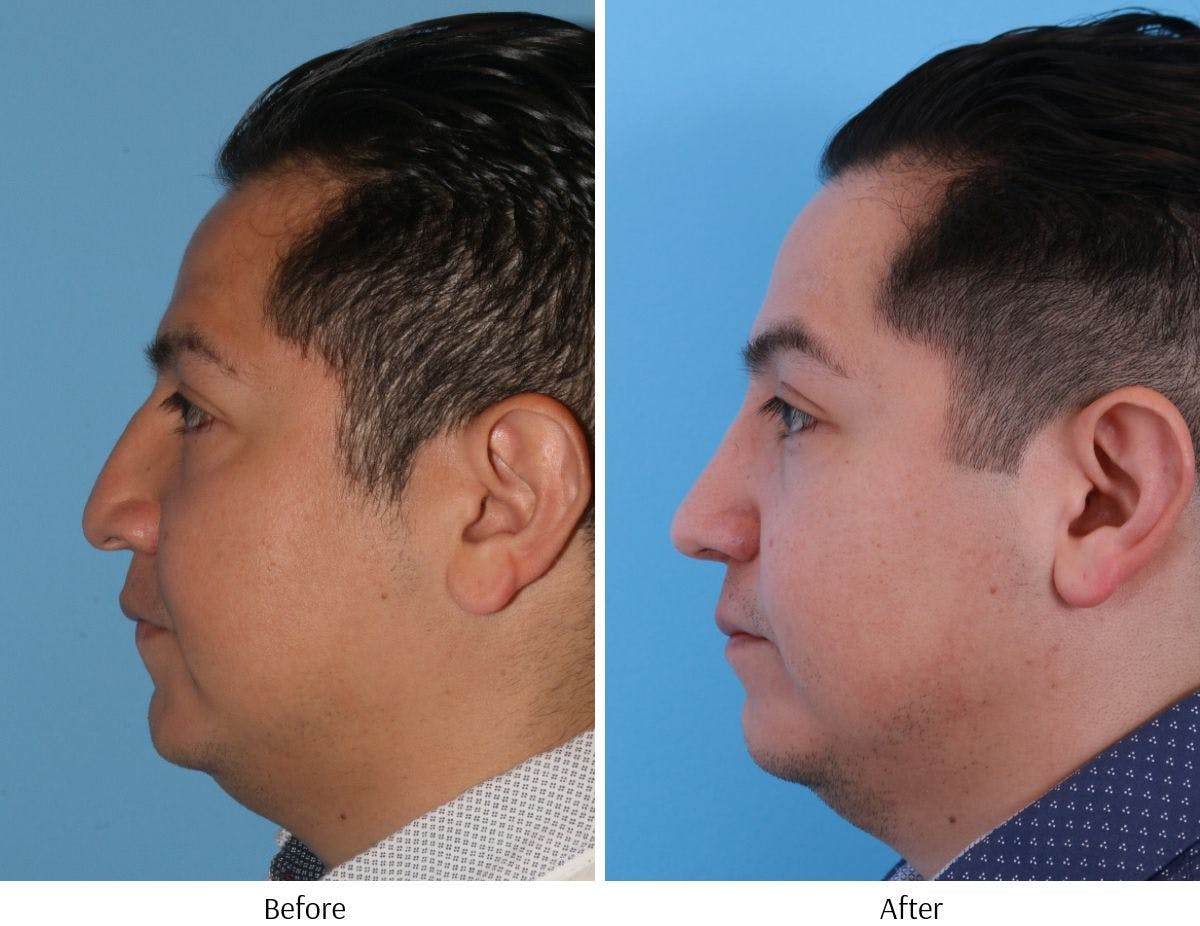 Revision Rhinoplasty Before & After Gallery - Patient 64081003 - Image 4