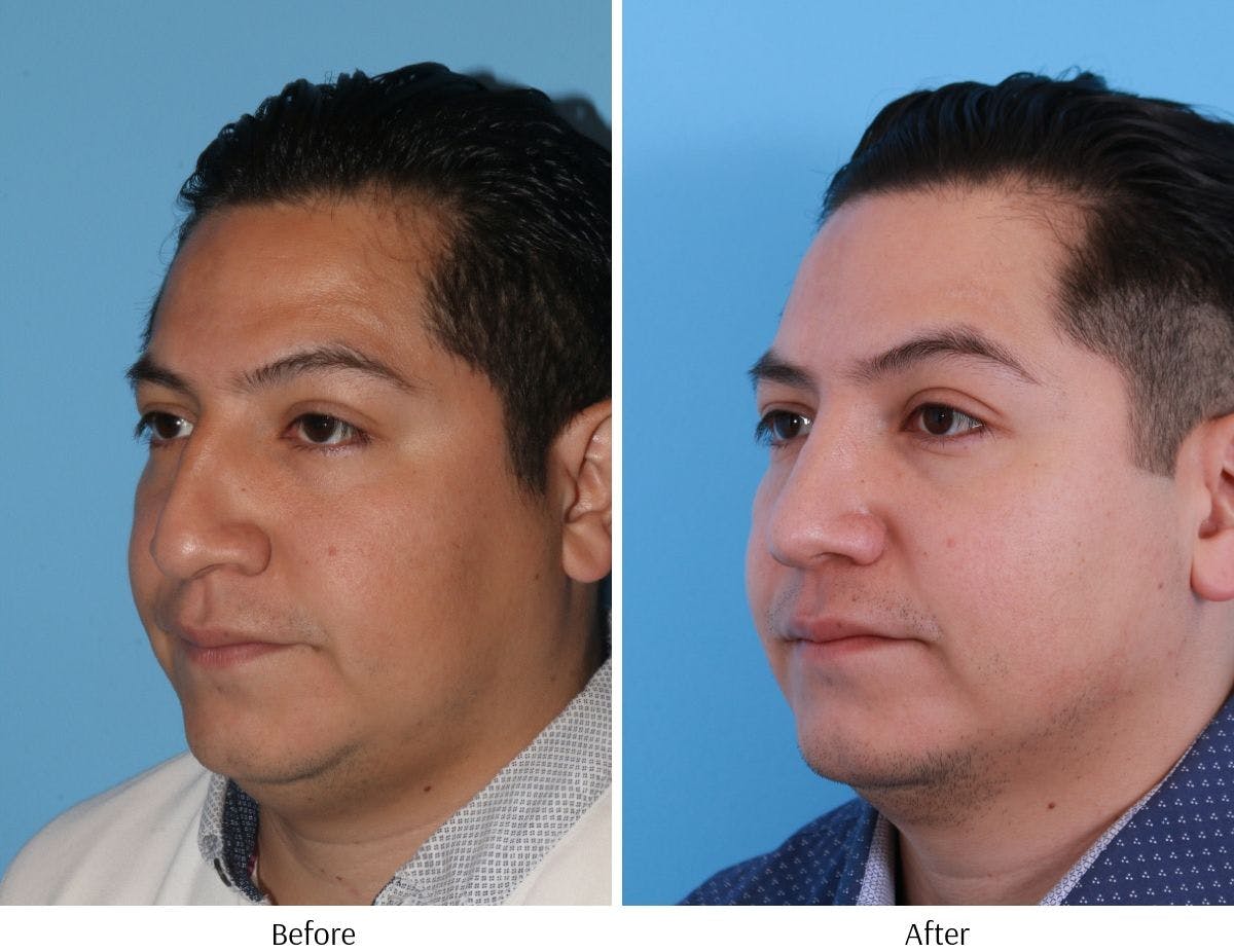 Revision Rhinoplasty Before & After Gallery - Patient 64081003 - Image 2